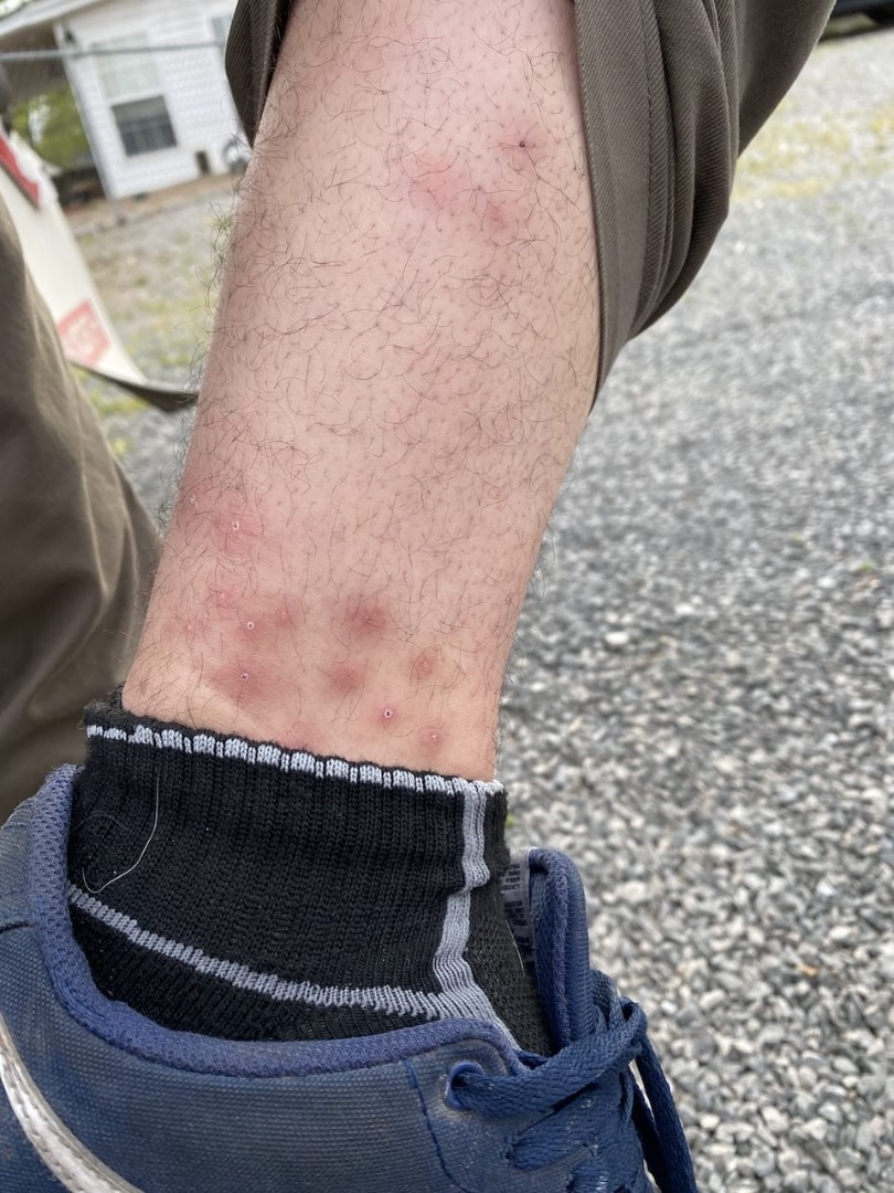 Bedbug bites and semis Peden Mill Kentucky