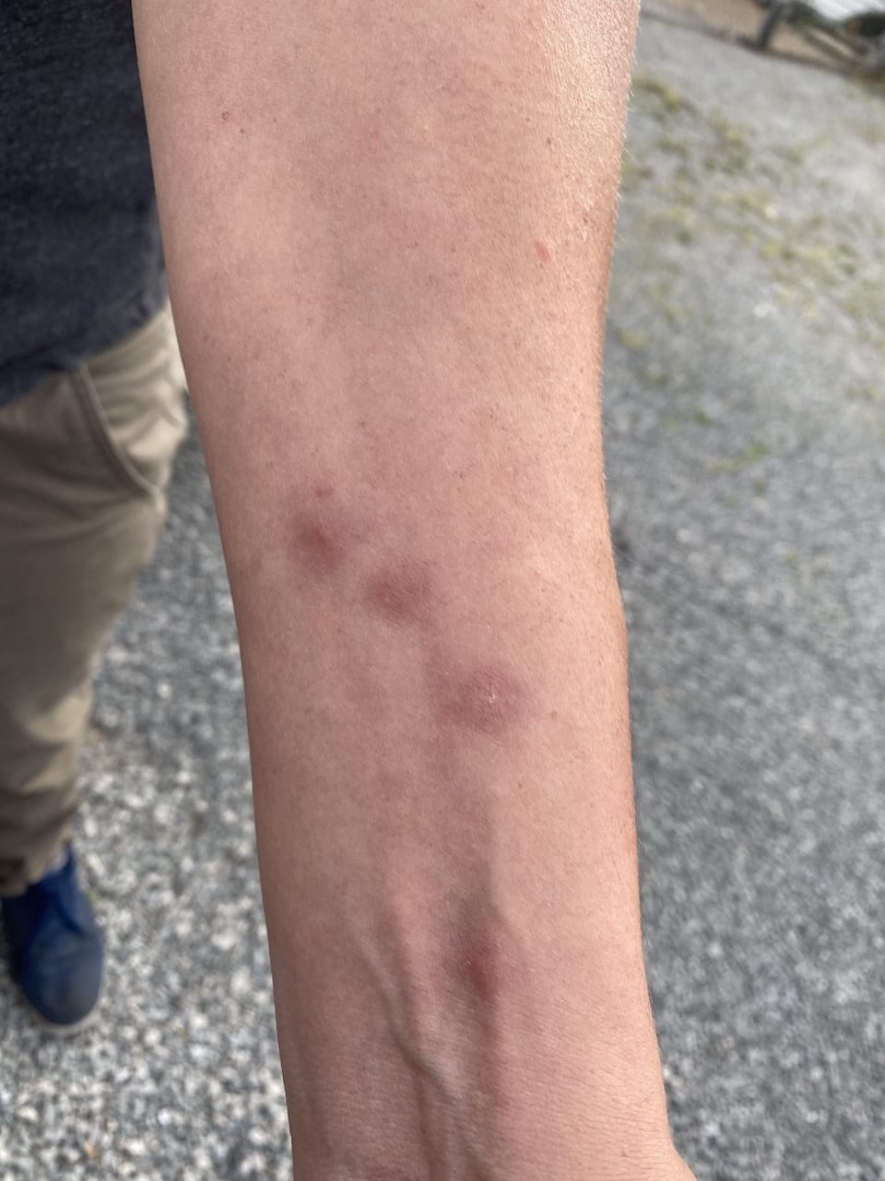 Bedbug bites and semis Geddes Kentucky